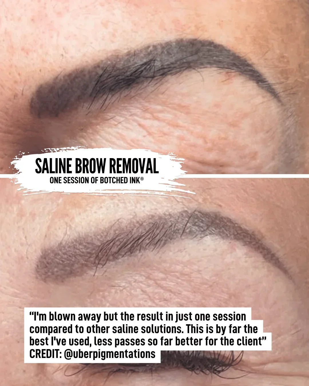 saline tattoo removal course free preview online training