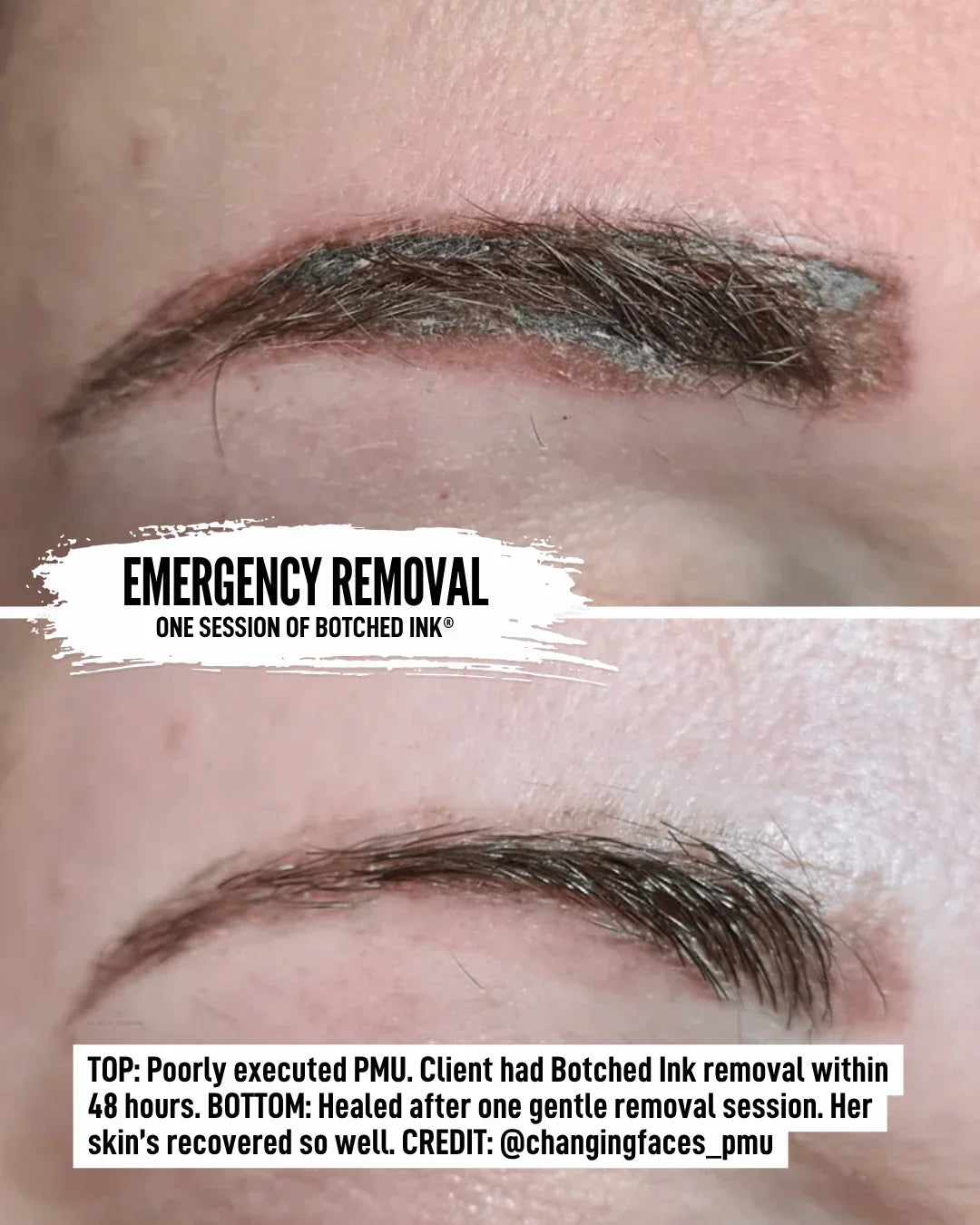 saline tattoo removal course free preview online training