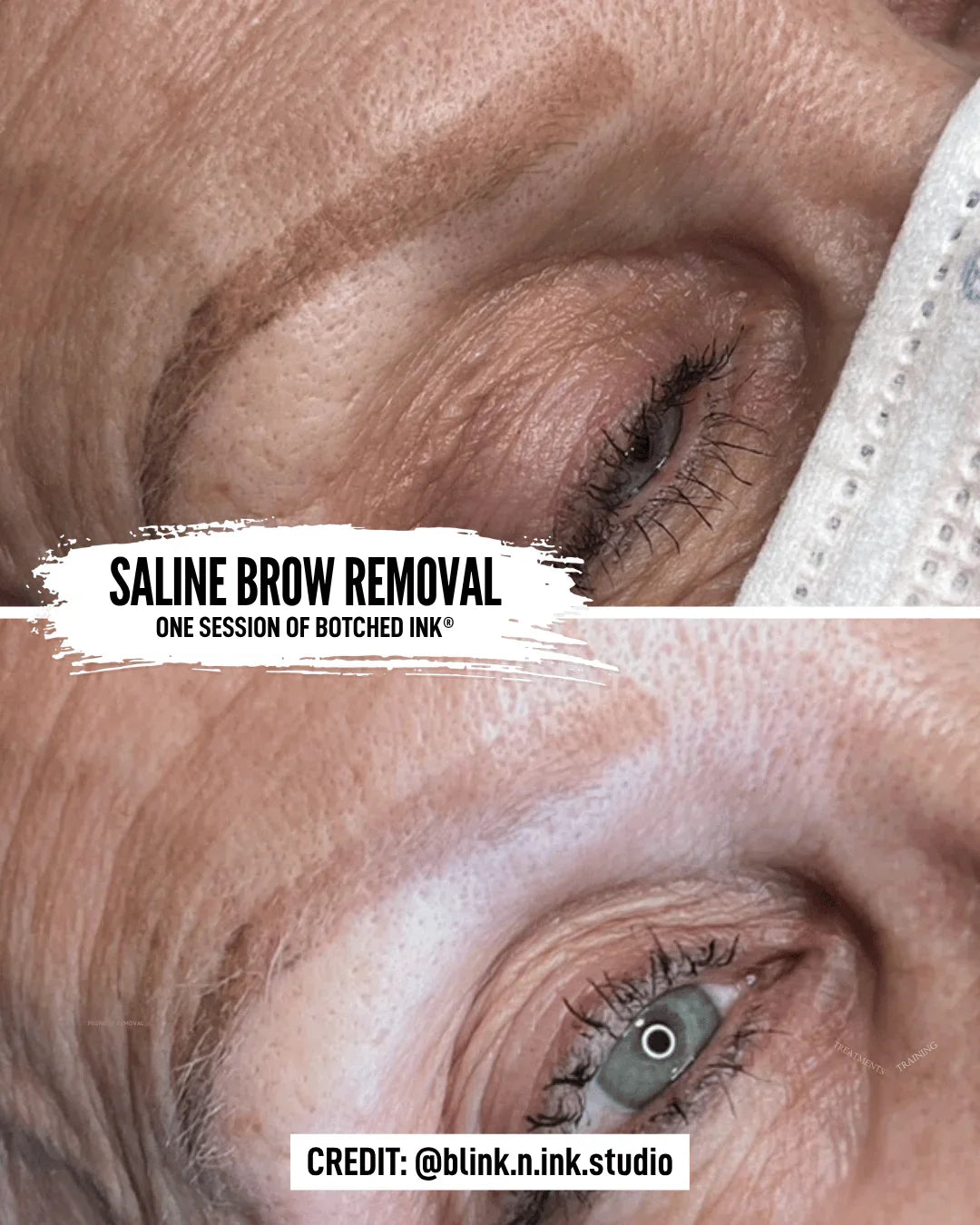 saline tattoo removal course free preview online training