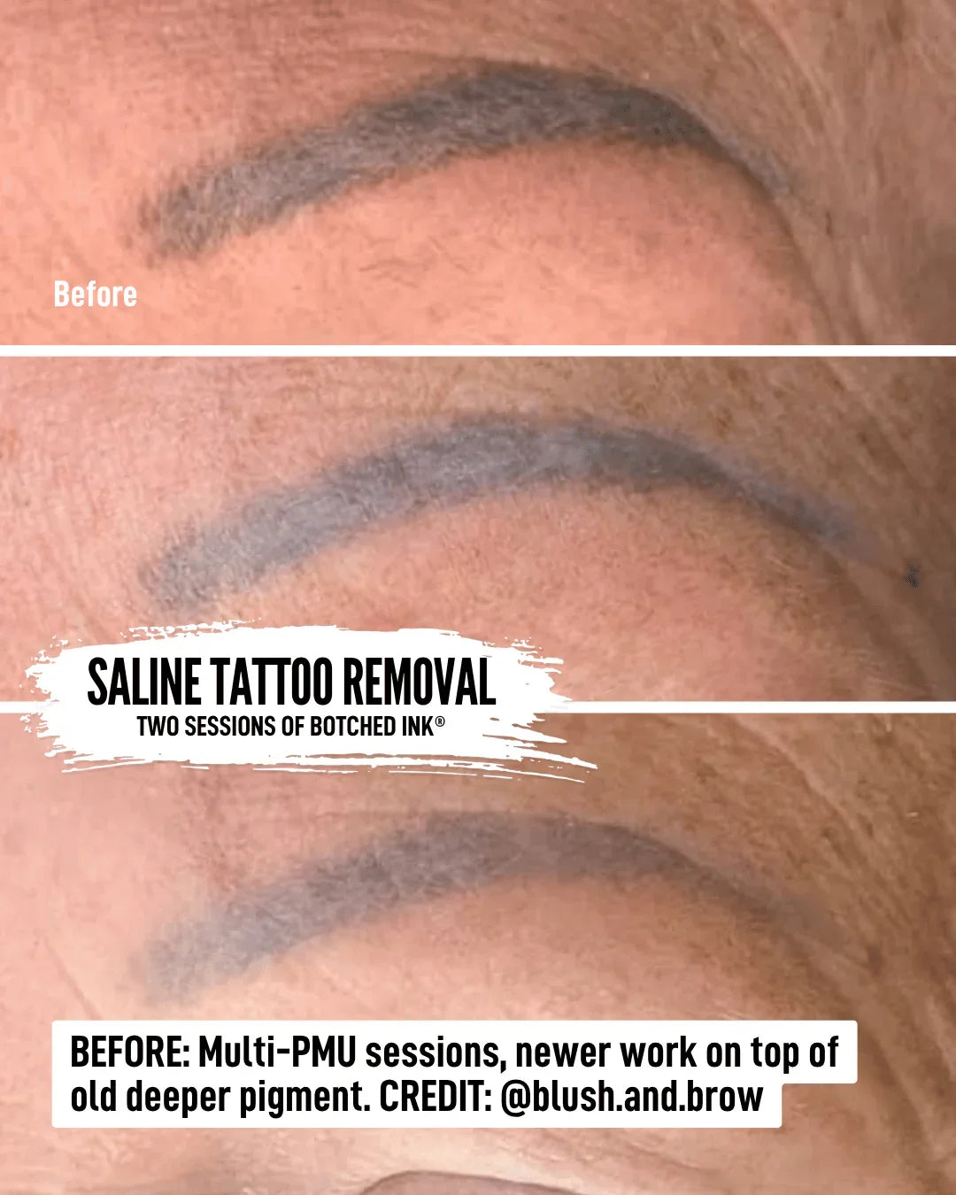 saline tattoo removal course free preview online training