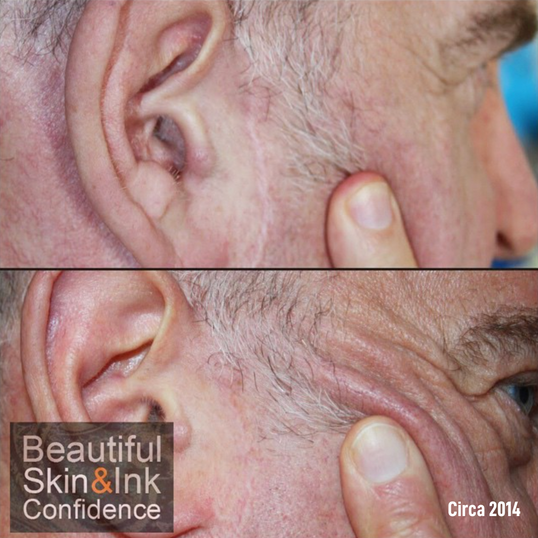 Dry Tattooing Scar and Stretch Mark Treatment