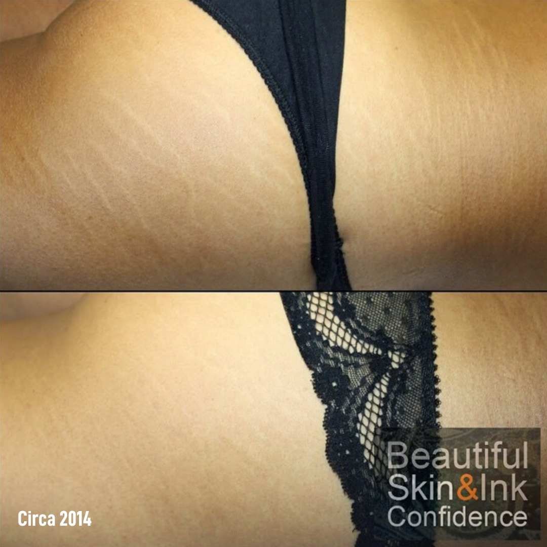 Dry Tattooing Scar and Stretch Mark Treatment