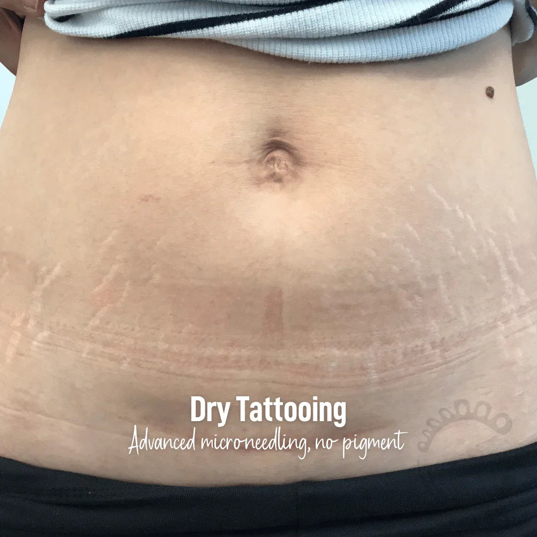 Dry Tattooing microneedling scar and stretch mark treatment near me