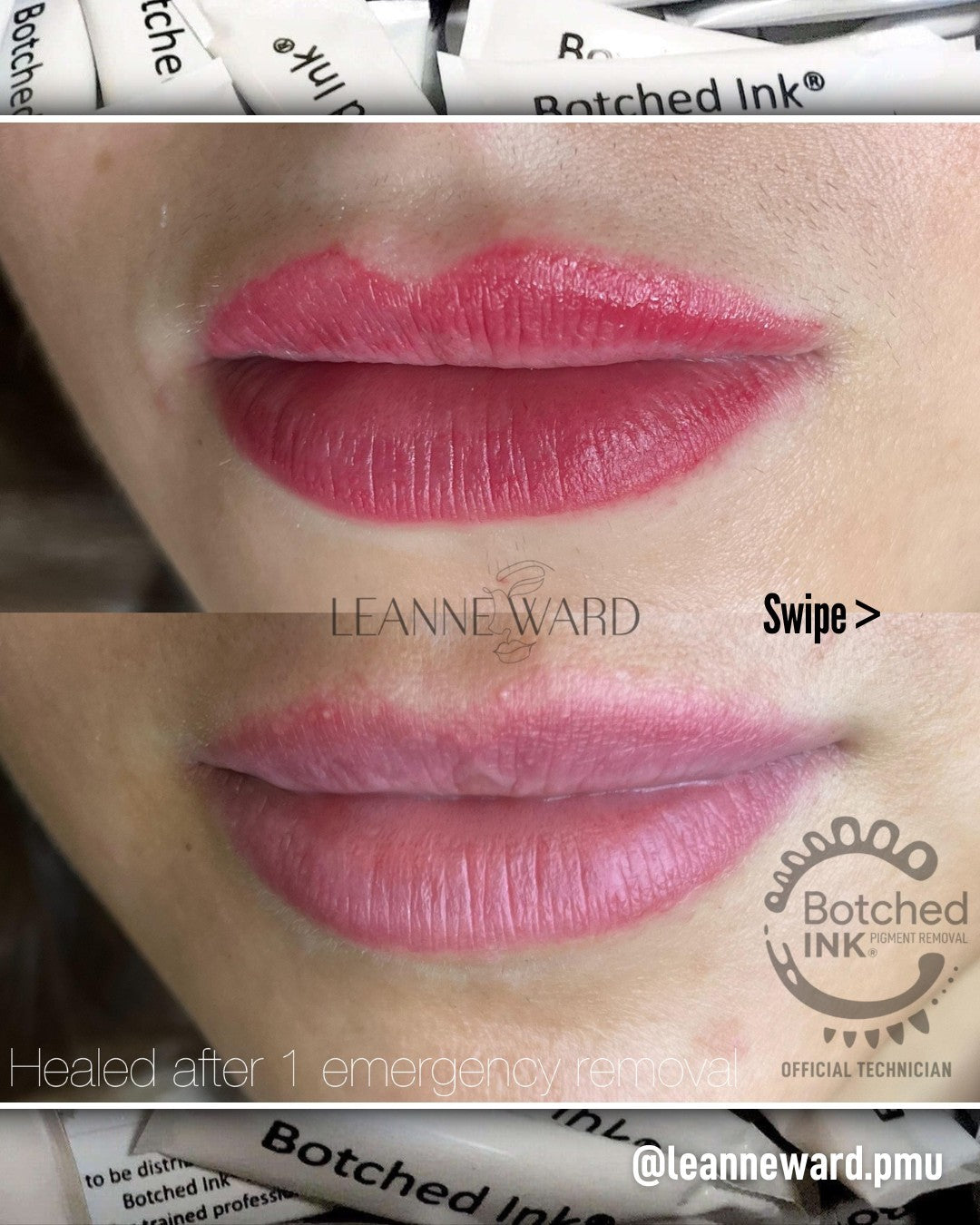 saline lip blush tattoo removal before after