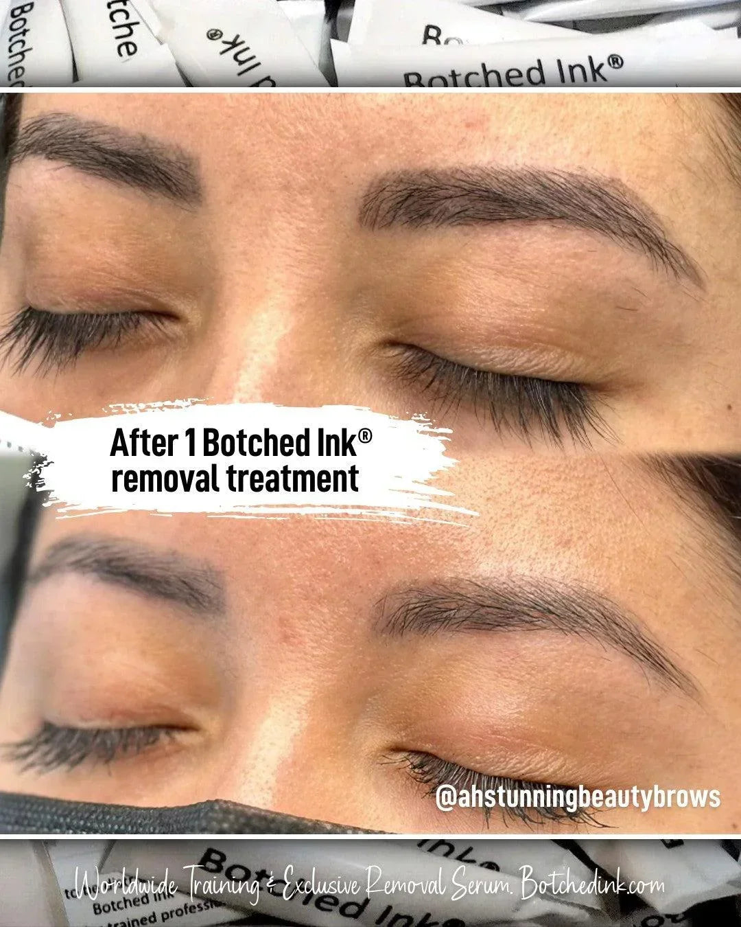 Botched Ink saline tattoo removal for microblading PMU permanent makeup eyebrow lip blush