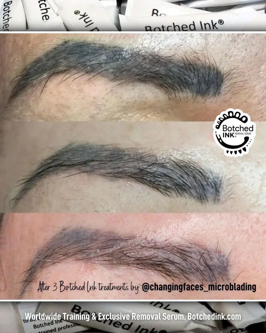 Botched Ink saline tattoo removal for microblading PMU permanent makeup eyebrow lip blush