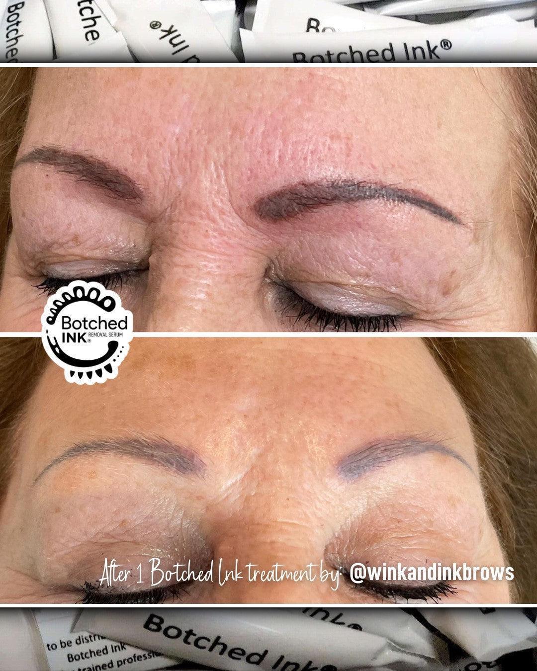 Botched Ink saline tattoo removal for microblading PMU permanent makeup eyebrow lip blush