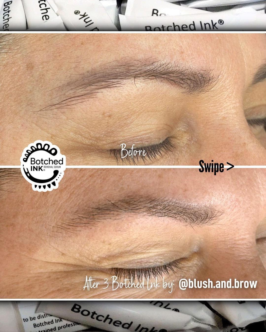 Botched Ink microblading and PMU eyebrow tattoo removal saline