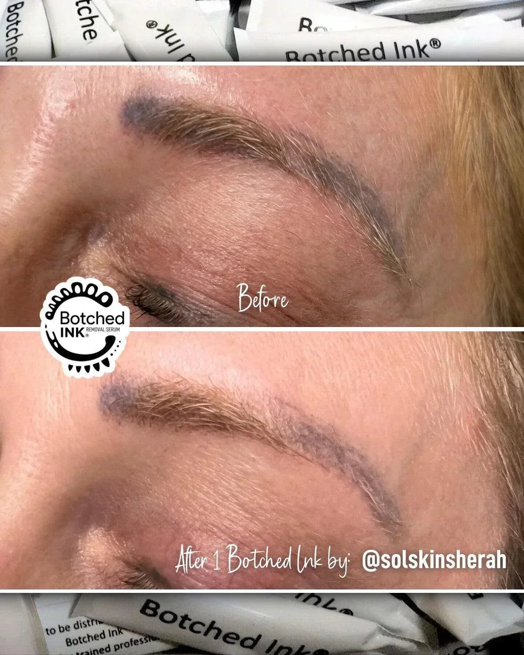 Botched Ink saline tattoo removal for microblading PMU permanent makeup eyebrow lip blush