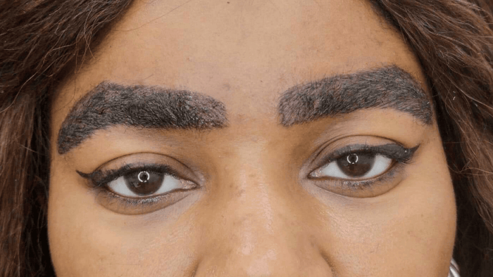 saline microblading removal non-laser tattoo removal of permanent makeup eyebrows