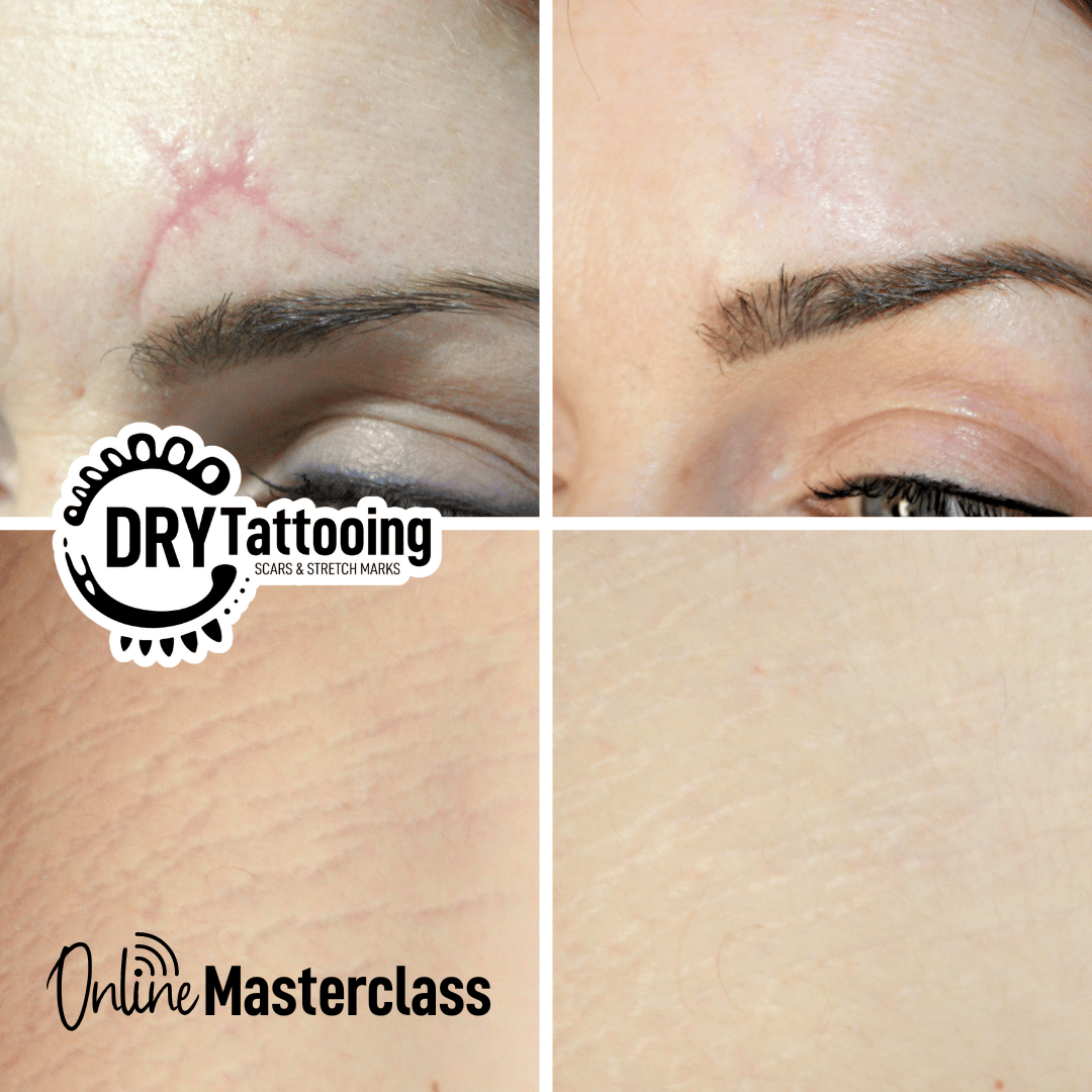 Dry Tattooing scars and stretch marks micro skin needling training course