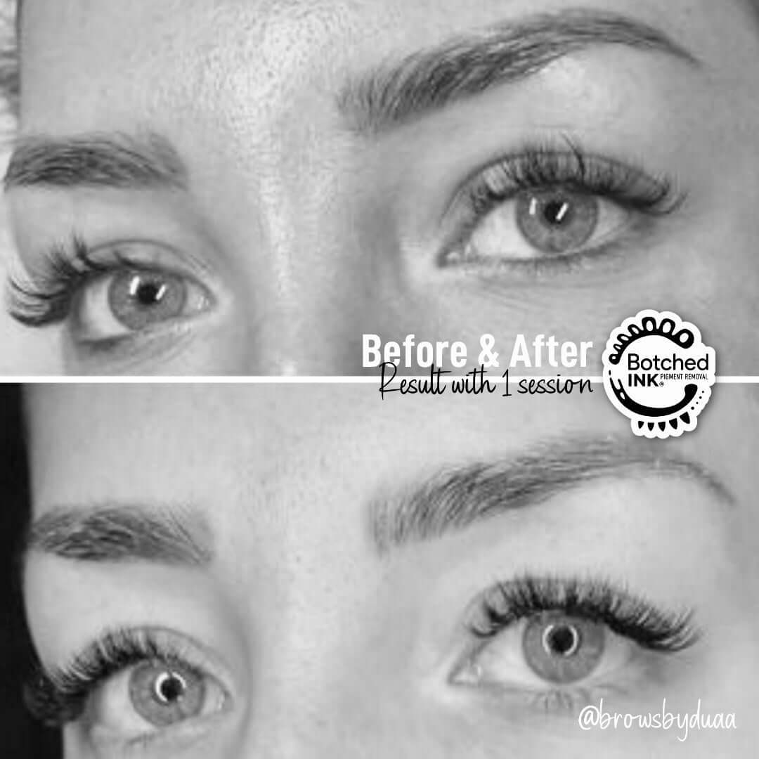 Microblading removal disaster get rid.  Botched Ink saline tattoo removal online training course webinar salt and saline microblading permanent makeup eyebrow tattoo
