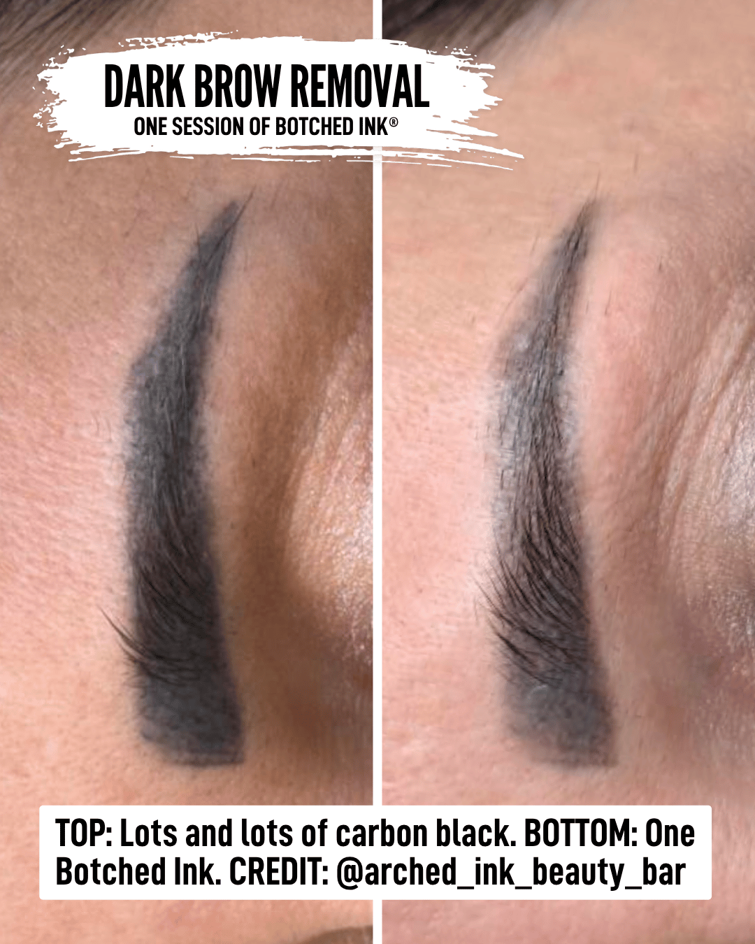 saline tattoo removal course free preview online training