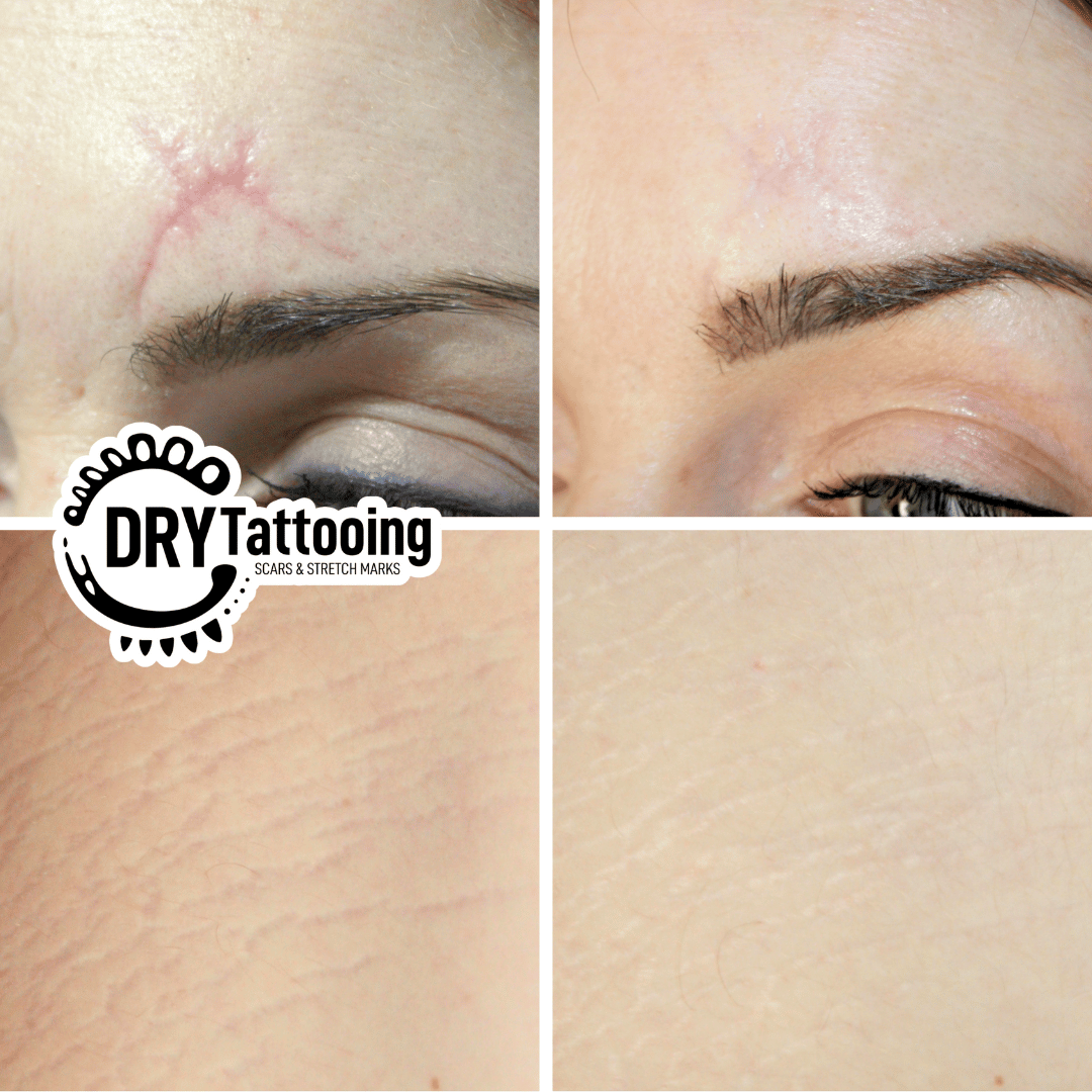 Dry Tattooing scars and stretch marks training course