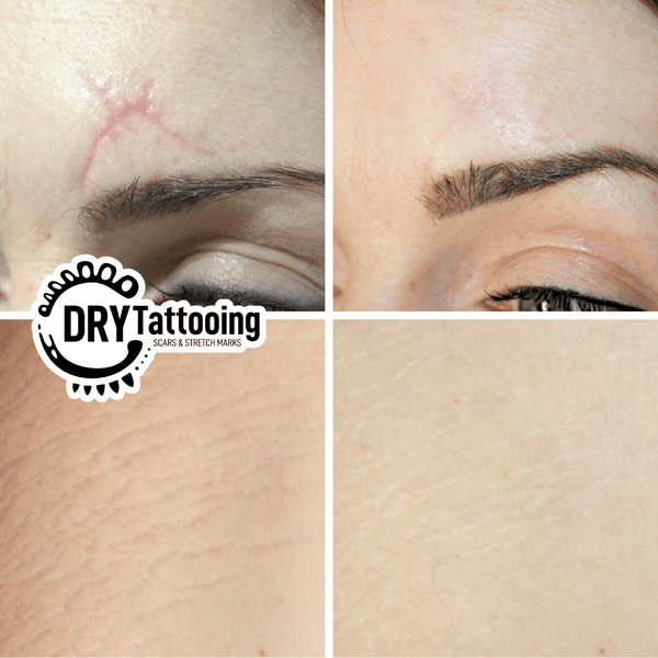 Dry Tattooing Stretch Mark Camouflage Removal Course – Botched Ink