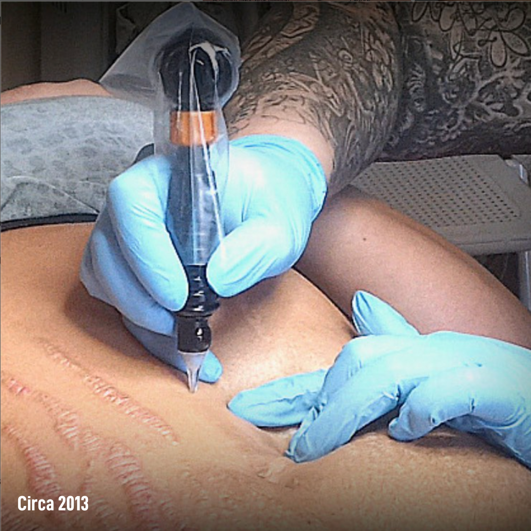 Dry Tattooing Scar and Stretch Mark Treatment