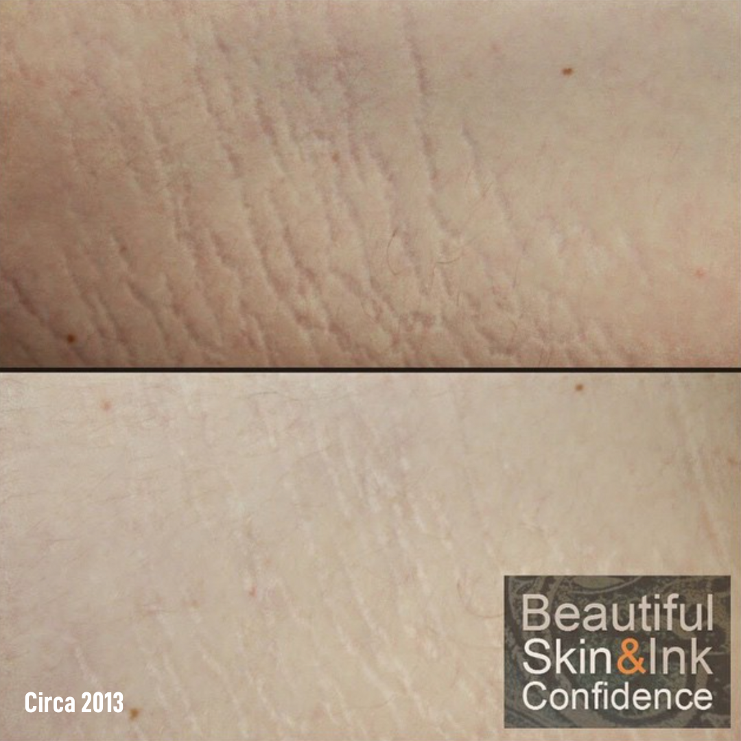 Dry Tattooing Scar and Stretch Mark Treatment