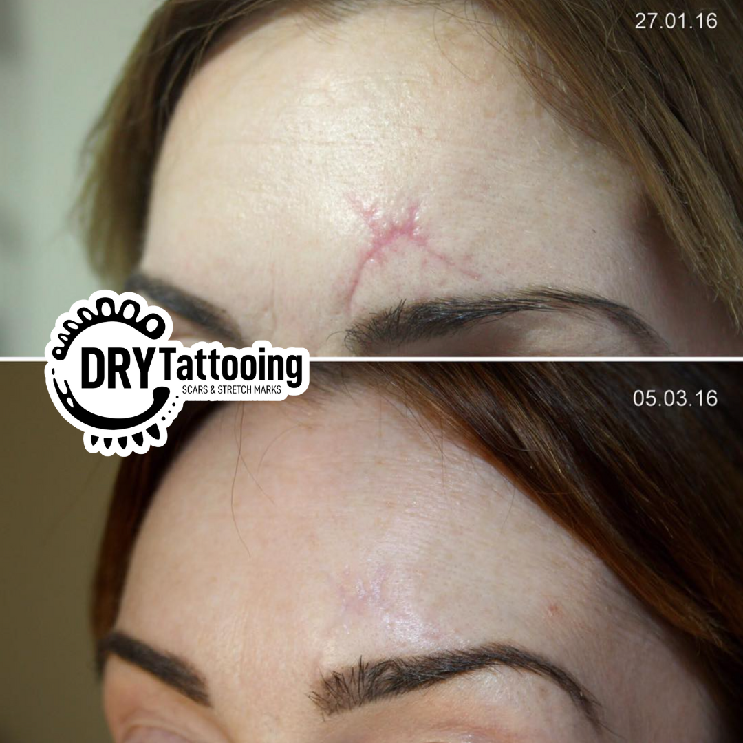Dry Tattooing Scar and Stretch Mark Treatment