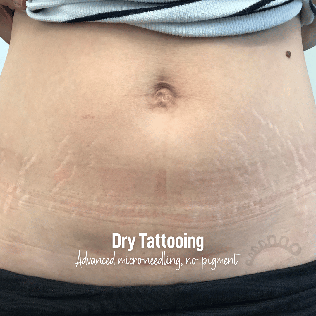 Dry Tattooing microneedling scar and stretch mark treatment near me