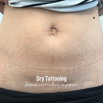 Botched Ink® Saline Tattoo Removal for Microblading, Eyebrows, Lips