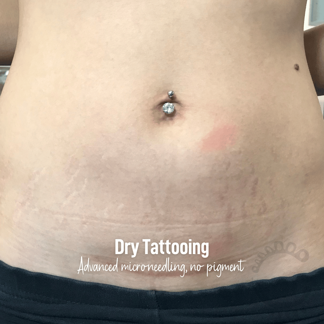 Dry Tattooing microneedling scar and stretch mark treatment near me