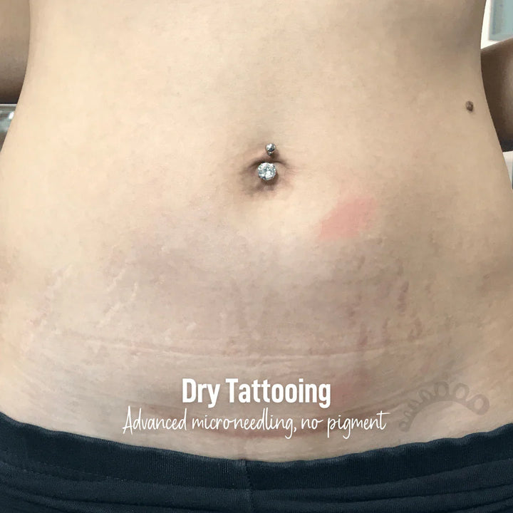 Dry Tattooing microneedling scar and stretch mark treatment near me