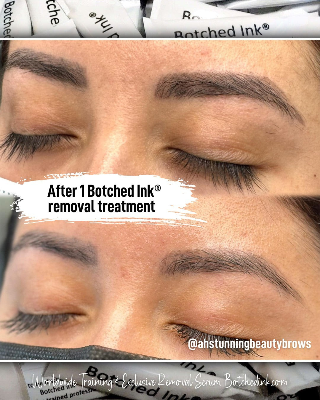 saline eyebrow tattoo removal before after